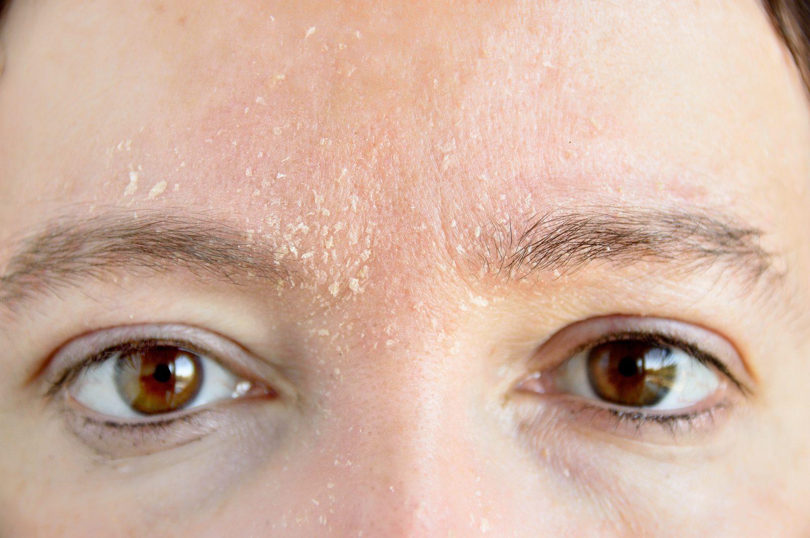 dry skin vs dehydrated skin close up of eyes and forehead