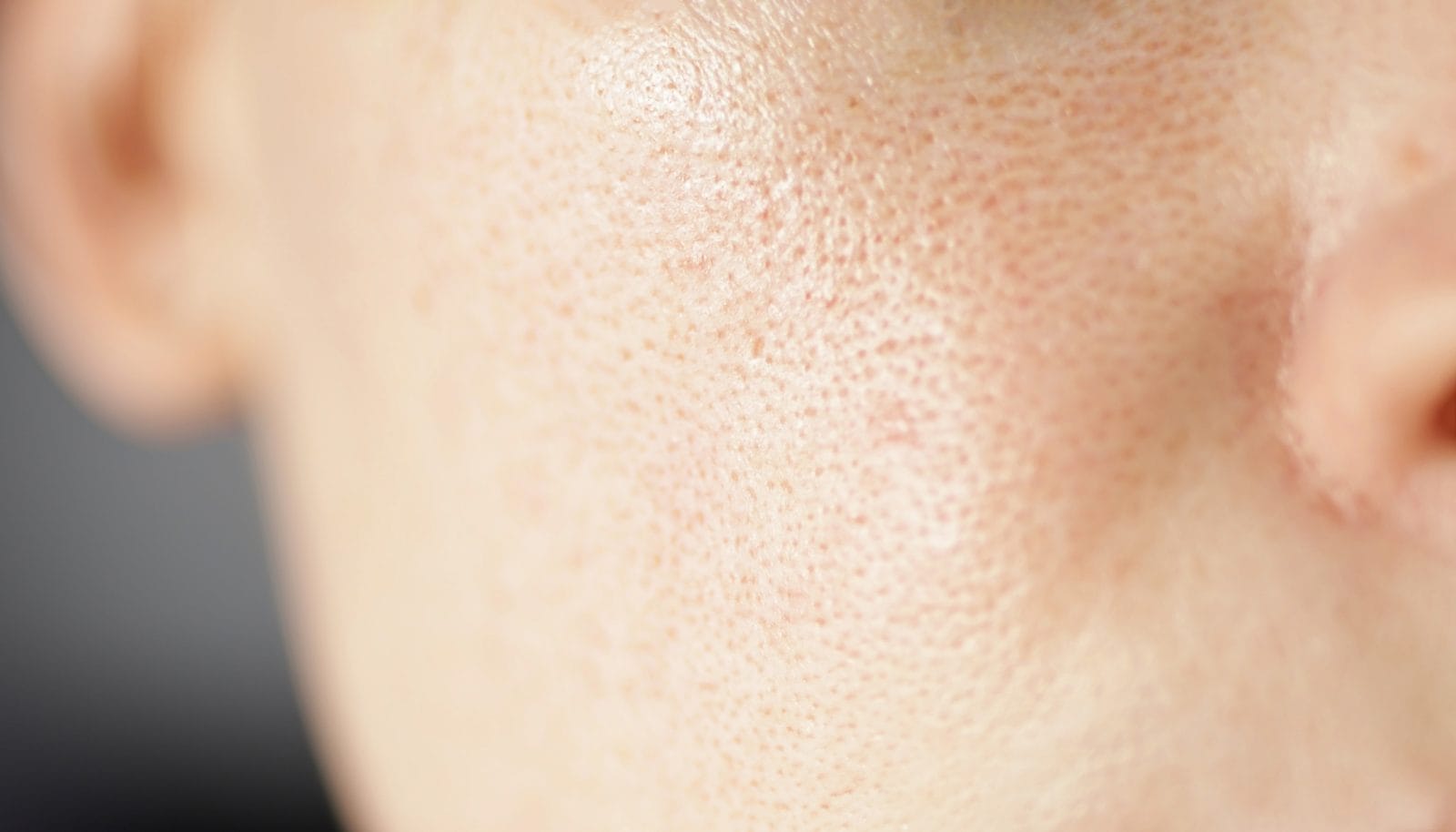 skin texture unhealthy with with enlarged pores a 2023 11 27 04 49 42 utc(2)