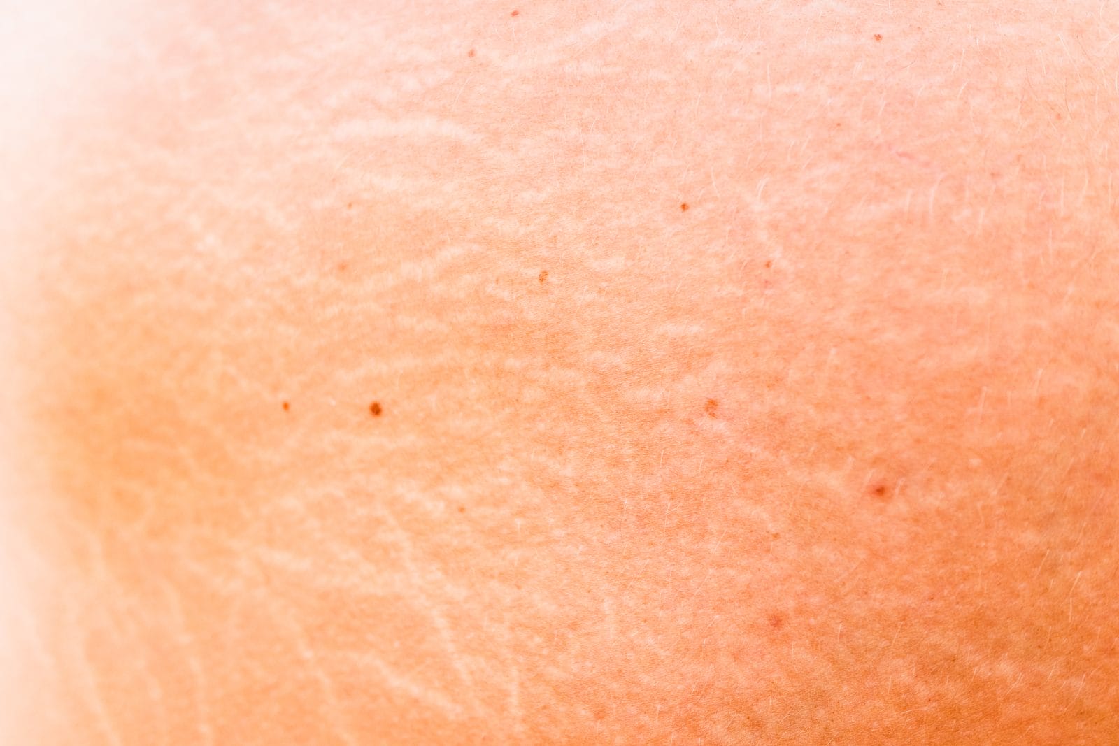 stretch marks on the skin of a middle aged woman, detail.